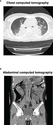 Case Report: A Patient With Neuroleptic Malignant Syndrome, Water Intoxication and Hyponatremia Associated With Severe Cerebral Edema and Coma